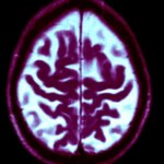 Demenza in aumento, ma il tuo rischio personale è in calo