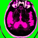 Buone notizie dalla ricerca sull'Alzheimer, spiegate