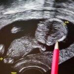 Should you get genetic screening before you have a child?